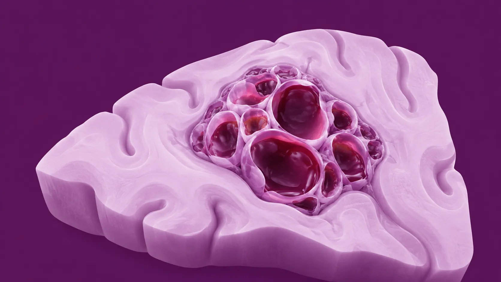 carte cavernome cerebral