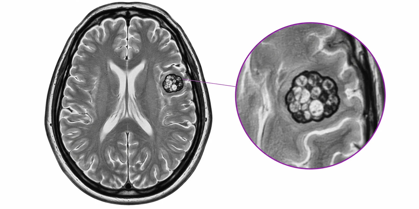cavernome cerebral aspect pop corn irm